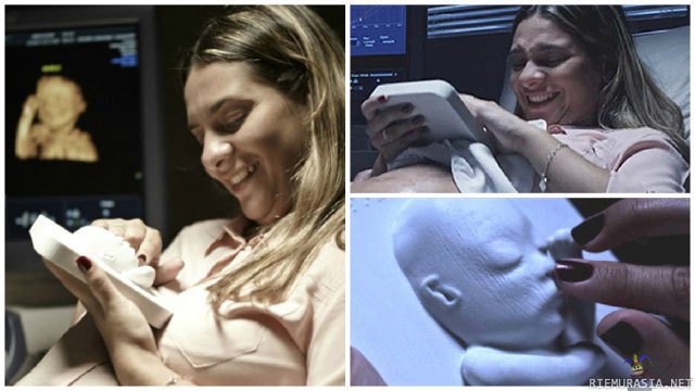 3D tulostettu mallinnos vauvasta - 3D-tulostettu mallinnos vauvasta että sokea äiti voi koskettaa syntymättömän lapsensa kasvoja ultraäänessä käytyään