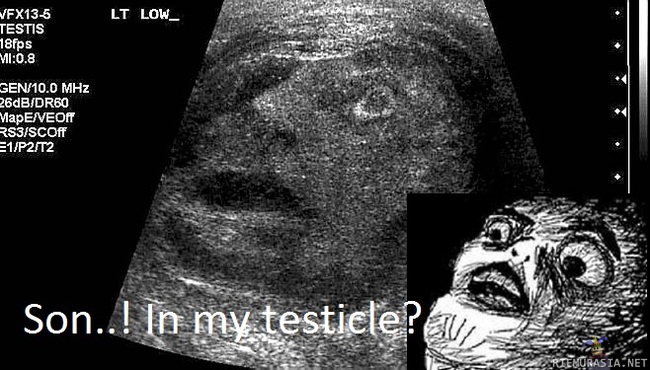 Meemi kiveksessä - Miehen kiveksestä otetusta ultraäänikuvasta löytyi kasvot http://bit.ly/twLURb