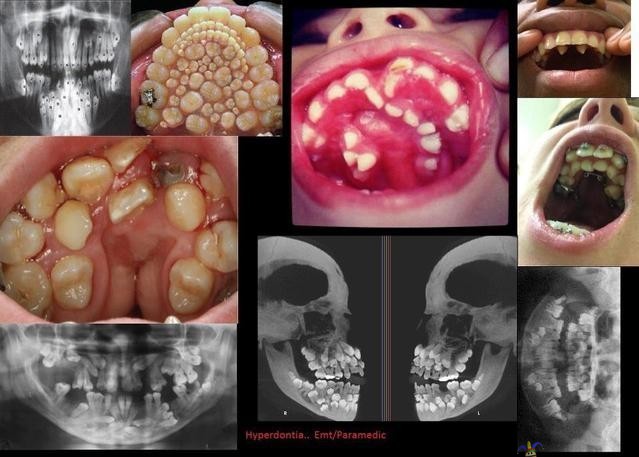 Hyperdontia - Hampaita, hampaita kaikkialla