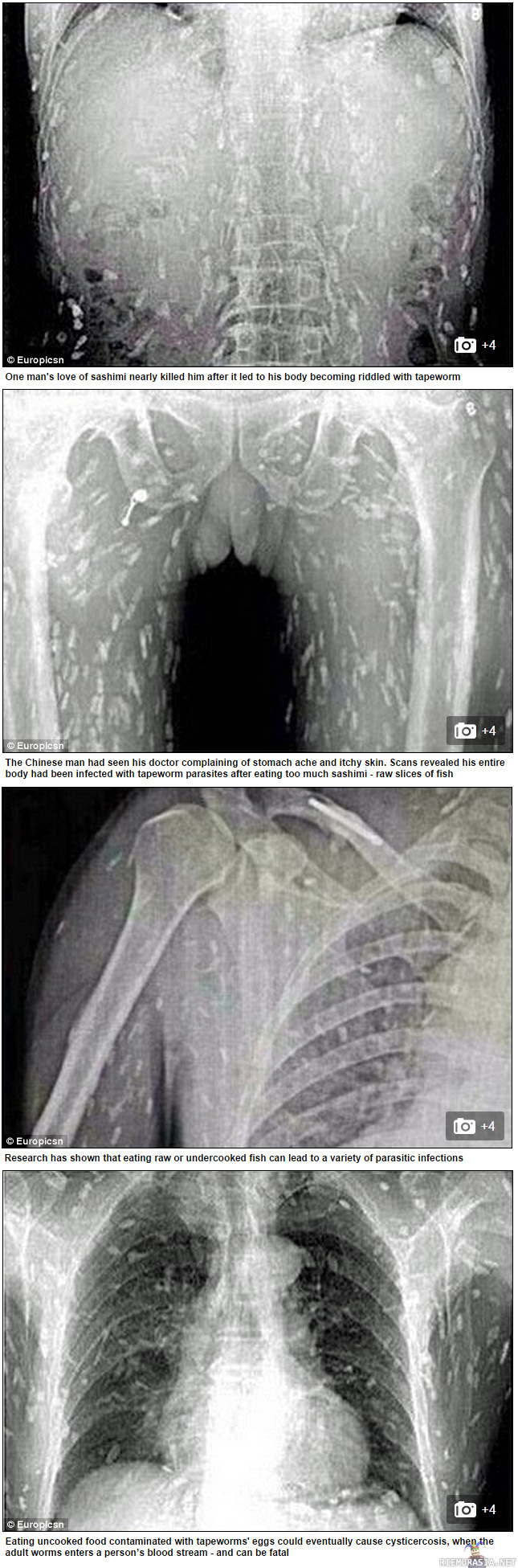 Sushin ystäville - Kiinalainen mies hakeutui lääkäriin vatsakipujen ja kutisevan ihon takia. Syyksi oireille paljastui sadat/tuhannet lapamadot, jotka olivat levinneet lähes koko kroppaan aiheuttaen hengenvaaran. Loistartunta on luultavimmin peräisin hepun nauttimasta sushista. Lisää: http://www.dailymail.co.uk/health/article-2768117/Sushi-lover-s-entire-body-left-riddled-tapeworm-parasites-eating-contaminated-sashimi.html
